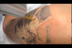 ok! TV - PicoWay Tattoo Removal Laser